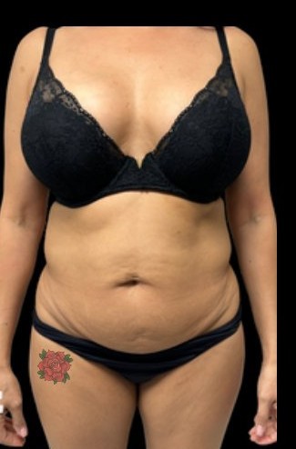 Before: Tummy tuck, hi-def lipo & BBL — front · by Dr. Tolomeo