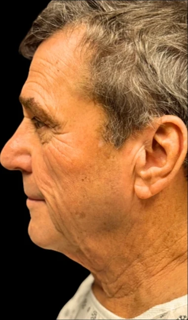 Before: Lower Face & Neck Lift — profile · by Angelo Cuzalina, MD, DDS