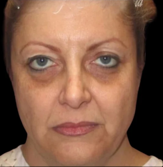 Before: Blepharoplasty, Laser Skin Resurfacing · by Angelo Cuzalina, MD, DDS