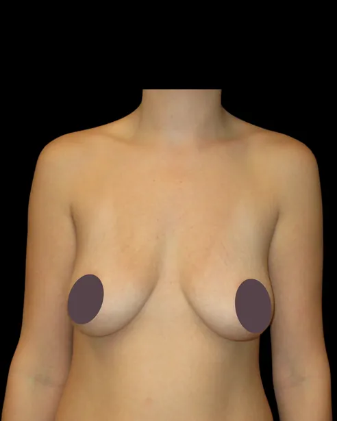 Antes: Levantamiento de senos con implantes — frente · por Chase Nelson, DO