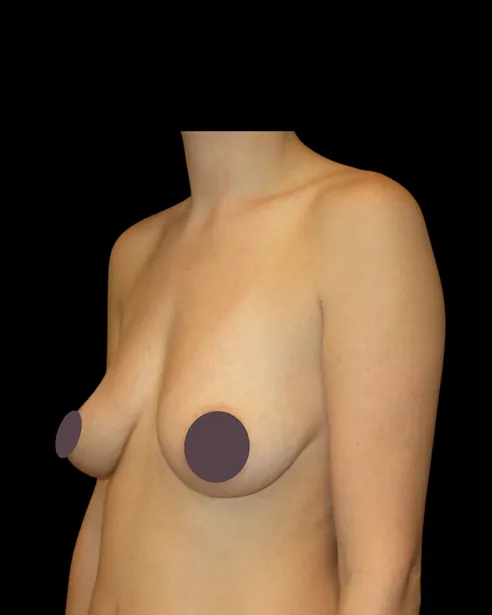 Antes: Levantamiento de senos con implantes — tres cuartos izquierdo · por Chase Nelson, DO