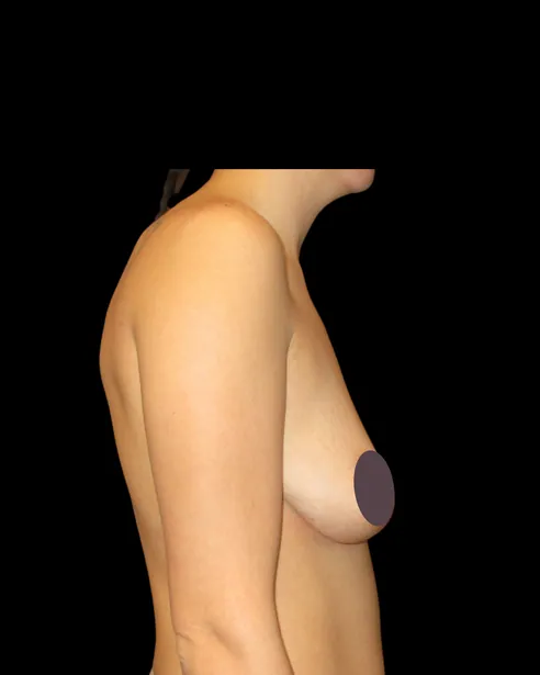 Antes: Levantamiento de senos con implantes — perfil derecho · por Chase Nelson, DO