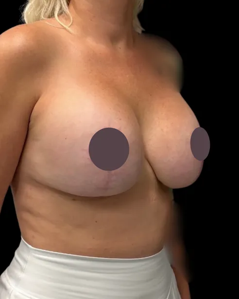 Después: Levantamiento de senos con implantes — tres cuartos derecho · por Chase Nelson, DO