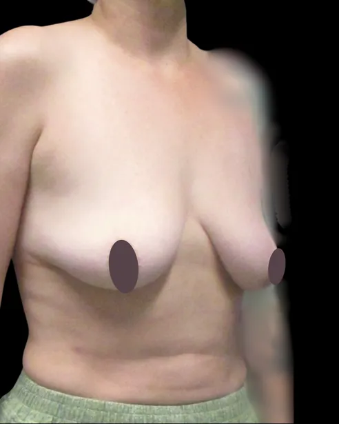 Antes: Levantamiento de senos con implantes — tres cuartos derecho · por Chase Nelson, DO