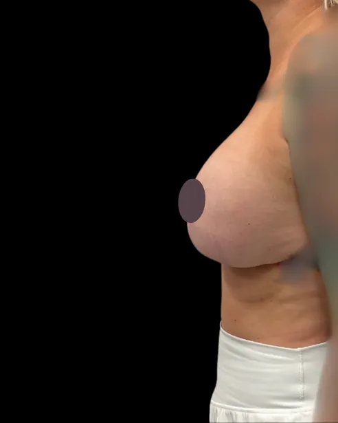 Después: Levantamiento de senos con implantes — perfil izquierdo · por Chase Nelson, DO