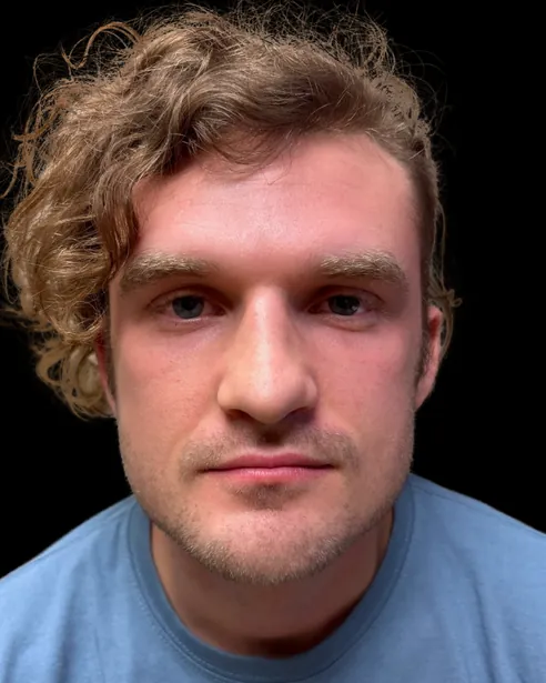 Después: Rinoplastia — frente · por Chase Nelson, DO
