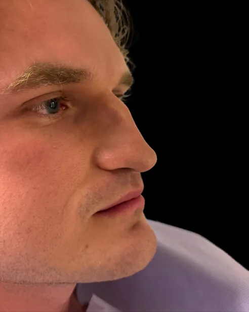 Antes: Rinoplastia — tres cuartos · por Chase Nelson, DO