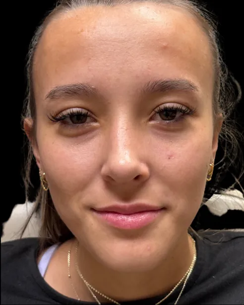 Después: Rinoplastia — frente · por Chase Nelson, DO