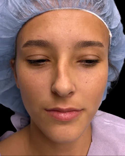 Antes: Rinoplastia — frente · por Chase Nelson, DO