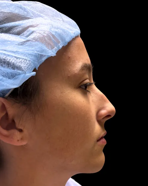 Antes: Rinoplastia — perfil derecho · por Chase Nelson, DO