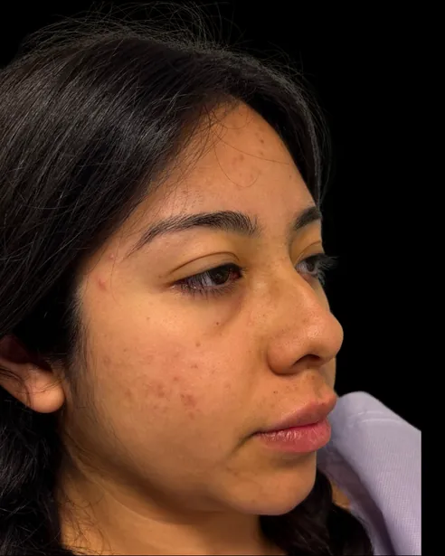 Antes: Rinoplastia — tres cuartos derecho · por Chase Nelson, DO