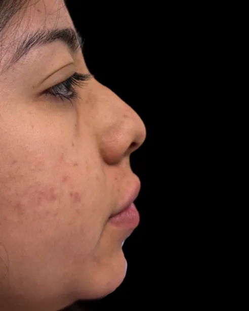 Antes: Rinoplastia — perfil derecho · por Chase Nelson, DO