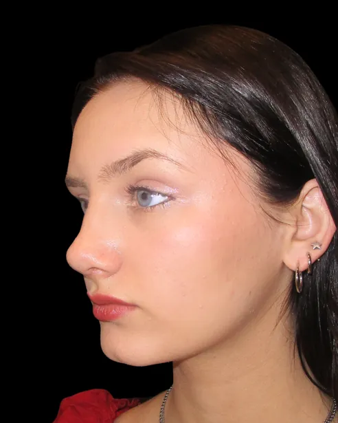 Después: Rinoplastia — tres cuartos izquierdo · por Chase Nelson, DO