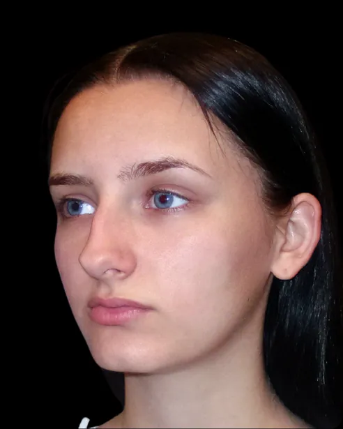 Antes: Rinoplastia — tres cuartos izquierdo · por Chase Nelson, DO