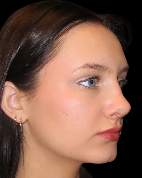 Después: Rinoplastia — tres cuartos derecho · por Chase Nelson, DO