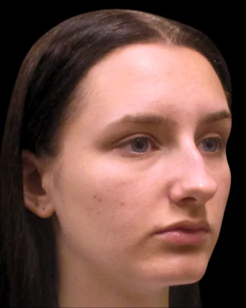 Antes: Rinoplastia — tres cuartos derecho · por Chase Nelson, DO
