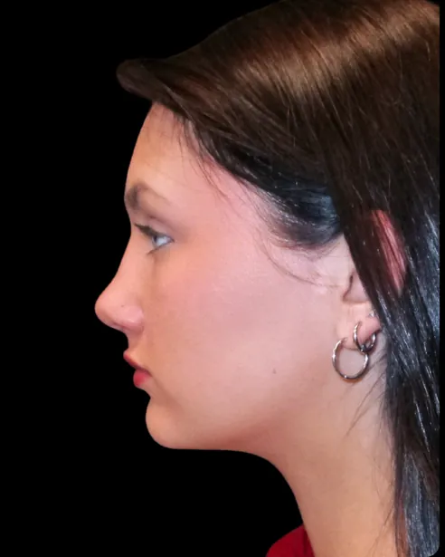 Después: Rinoplastia — perfil izquierdo · por Chase Nelson, DO
