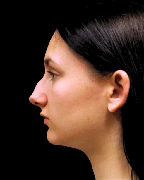 Antes: Rinoplastia — perfil izquierdo · por Chase Nelson, DO