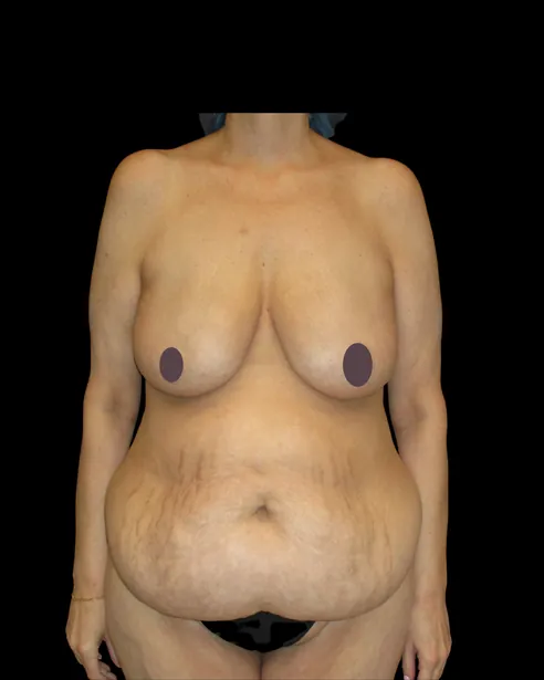 Antes: Abdominoplastia — frente · por Chase Nelson, DO