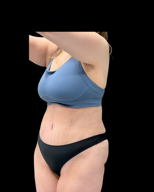 Después: Abdominoplastia — tres cuartos izquierdo · por Chase Nelson, DO