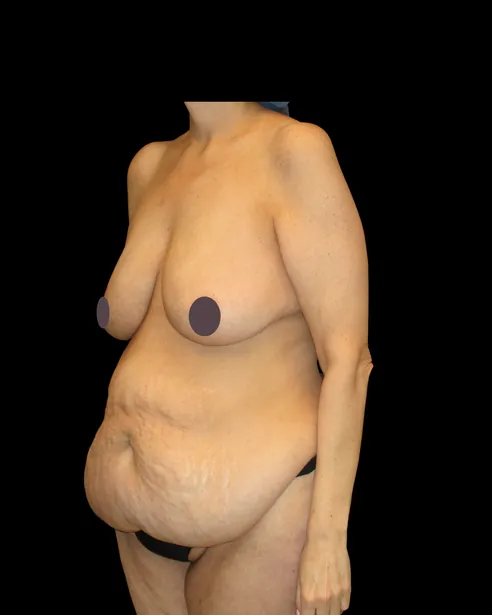 Antes: Abdominoplastia — tres cuartos izquierdo · por Chase Nelson, DO
