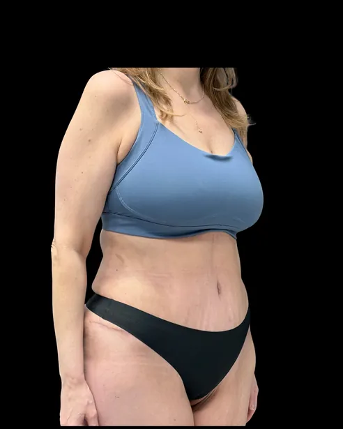 Después: Abdominoplastia — tres cuartos derecho · por Chase Nelson, DO