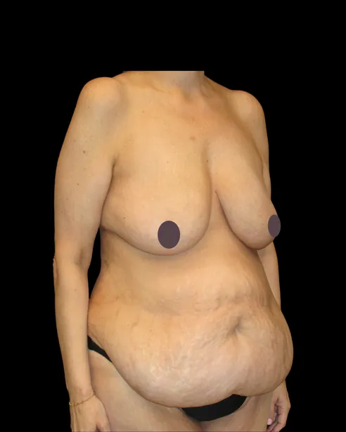 Antes: Abdominoplastia — tres cuartos derecho · por Chase Nelson, DO