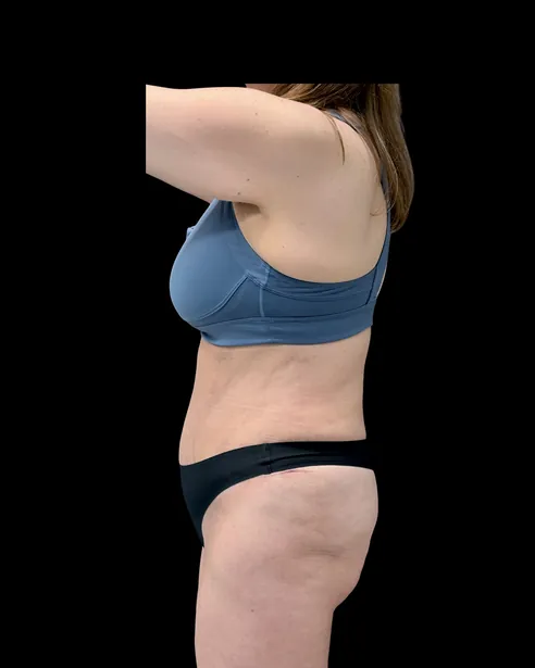 Después: Abdominoplastia — perfil izquierdo · por Chase Nelson, DO