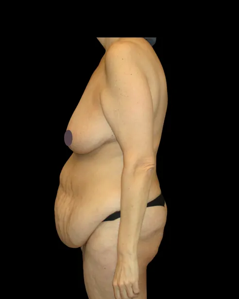 Antes: Abdominoplastia — perfil izquierdo · por Chase Nelson, DO