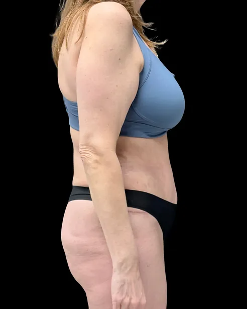 Después: Abdominoplastia — perfil derecho · por Chase Nelson, DO