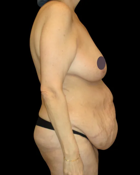 Antes: Abdominoplastia — perfil derecho · por Chase Nelson, DO