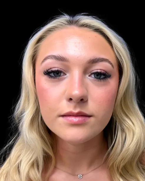 Después: Rinoplastia ultrasónica — frente · por Chase Nelson, DO