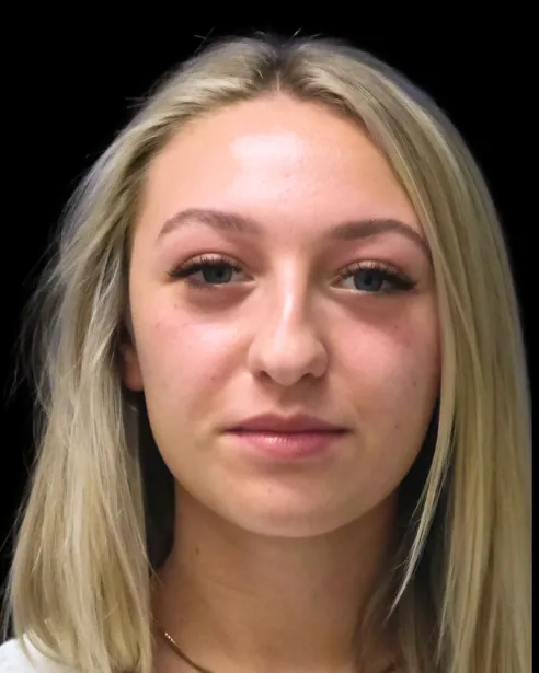 Antes: Rinoplastia ultrasónica — frente · por Chase Nelson, DO