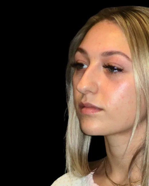 Antes: Rinoplastia ultrasónica — tres cuartos izquierdo · por Chase Nelson, DO
