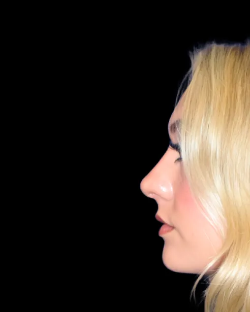 After: Ultrasonic rhinoplasty — left profile · by Dr. Nelson