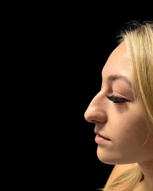 Before: Ultrasonic rhinoplasty — left profile · by Dr. Nelson