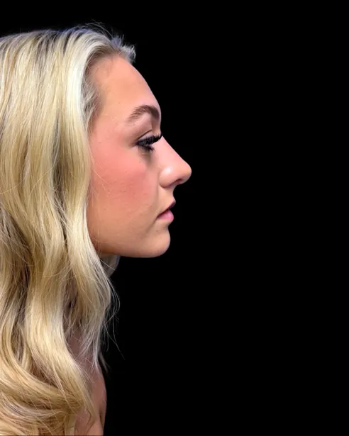 Después: Rinoplastia ultrasónica — perfil derecho · por Chase Nelson, DO
