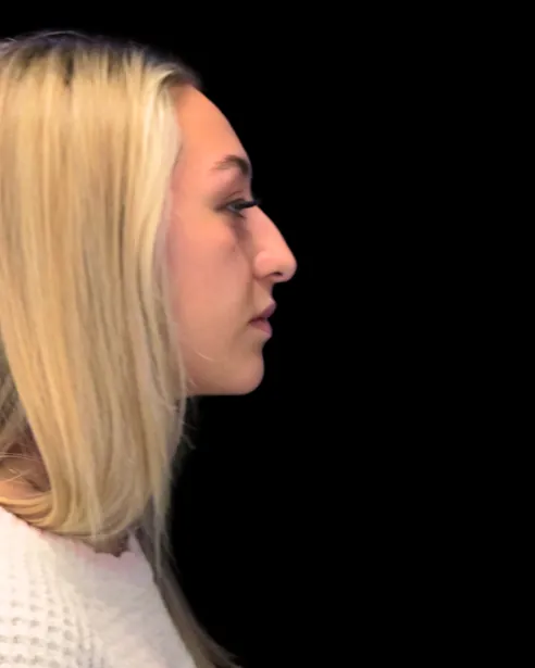 Antes: Rinoplastia ultrasónica — perfil derecho · por Chase Nelson, DO