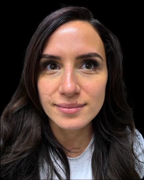 Antes: Rinoplastia ultrasónica — frente · por Chase Nelson, DO