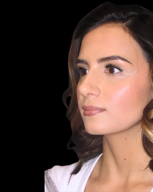 Después: Rinoplastia ultrasónica — tres cuartos izquierdo · por Chase Nelson, DO