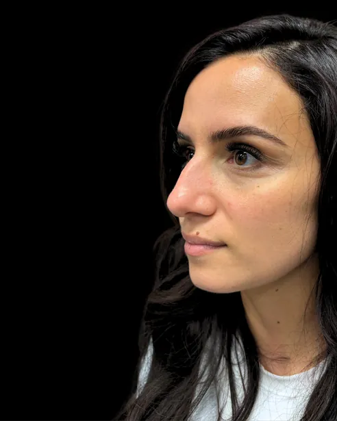Antes: Rinoplastia ultrasónica — tres cuartos izquierdo · por Chase Nelson, DO