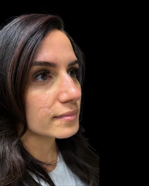Antes: Rinoplastia ultrasónica — tres cuartos derecho · por Chase Nelson, DO