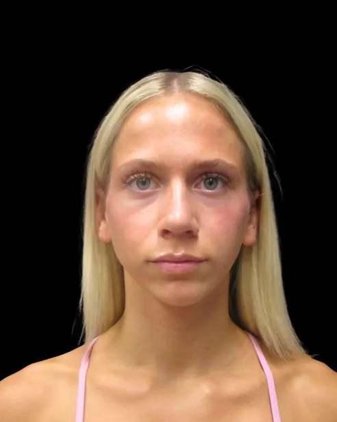 Después: Rinoplastia ultrasónica — frente · por Chase Nelson, DO
