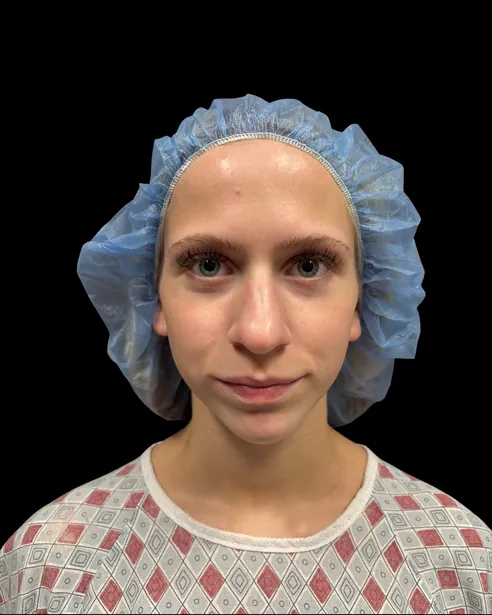 Antes: Rinoplastia ultrasónica — frente · por Chase Nelson, DO