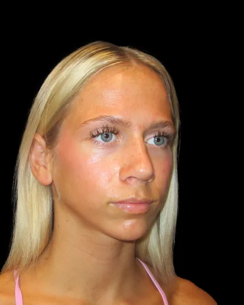 Después: Rinoplastia ultrasónica — tres cuartos derecho · por Chase Nelson, DO