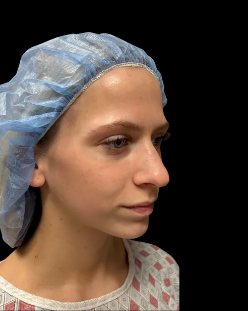 Antes: Rinoplastia ultrasónica — tres cuartos derecho · por Chase Nelson, DO