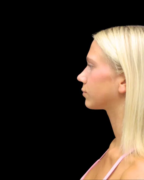 Después: Rinoplastia ultrasónica — perfil izquierdo · por Chase Nelson, DO