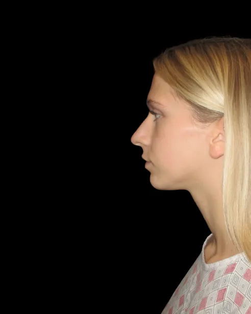 Antes: Rinoplastia ultrasónica — perfil izquierdo · por Chase Nelson, DO