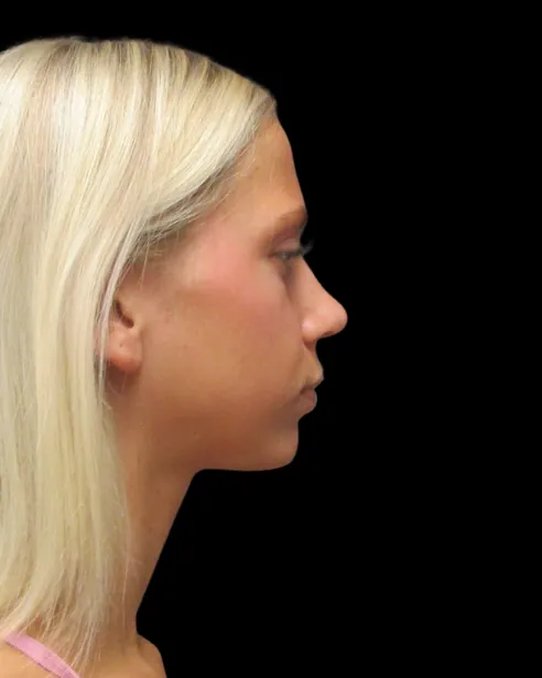 Después: Rinoplastia ultrasónica — perfil derecho · por Chase Nelson, DO