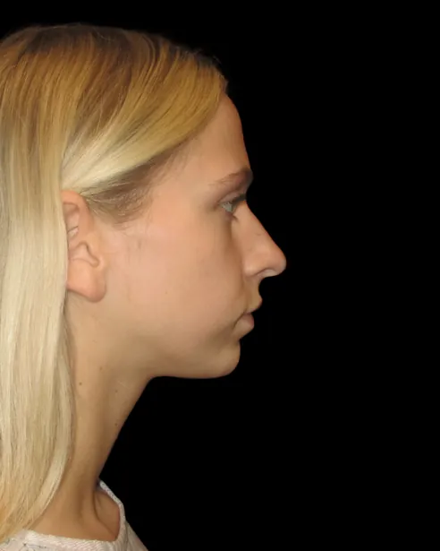 Antes: Rinoplastia ultrasónica — perfil derecho · por Chase Nelson, DO